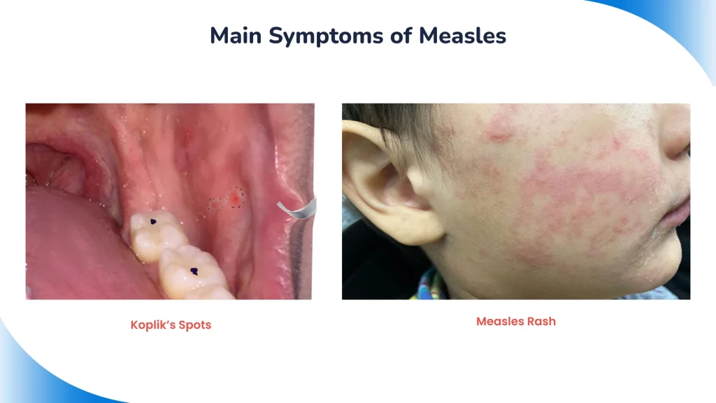 Main Symptoms of Measles